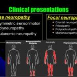 Διαβητική πολυνευροπάθεια